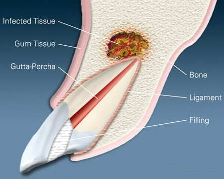 Apicoectomy Treatment with Comprehensive Guide