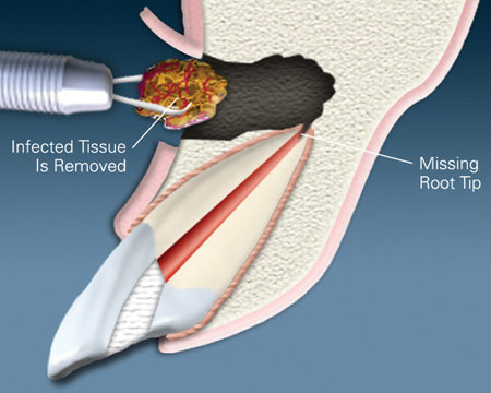 Apicoectomy Treatment with Comprehensive Guide