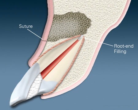 Apicoectomy Treatment with Comprehensive Guide