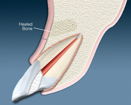 Apicoectomy Treatment with Comprehensive Guide