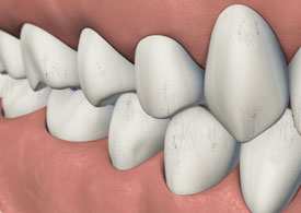 Cracked Teeth - Symptoms, Types & Treatment | Avondale Endodontics