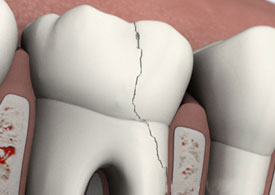 Cracked Teeth - Symptoms, Types & Treatment | Avondale Endodontics