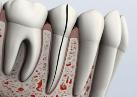 Cracked Teeth - Symptoms, Types & Treatment | Avondale Endodontics