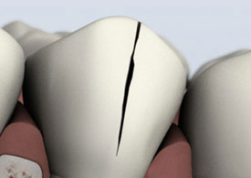 Cracked Teeth - Symptoms, Types & Treatment | Avondale Endodontics